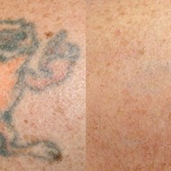 Open Canvas Tattoo Removal uses lasers to fade away ink and more