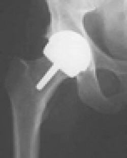 X-RAY VISION :  This is an x-ray of a hip with the Birmingham Hip Resurfacing device installed inside. - PHOTO COURTESY OF BIRMINGHAM HIP RESURFACING