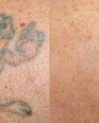 OPEN CANVAS TATTOO REMOVAL USES LASERS TO FADE AWAY INK AND MORE